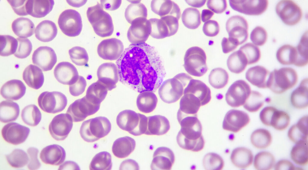 Toutes les monocytoses ne se ressemblent pas…